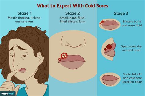 dating a person with cold sores